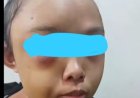 Miris, Gadis Yatim Piatu Di Kampar Jadi Korban Penganiayaan Oleh Tantenya Sendiri