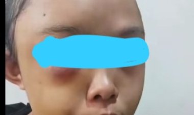 Miris, Gadis Yatim Piatu Di Kampar Jadi Korban Penganiayaan Oleh Tantenya Sendiri