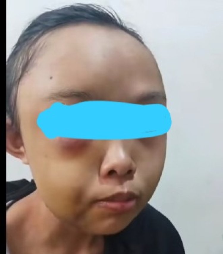 Miris, Gadis Yatim Piatu Di Kampar Jadi Korban Penganiayaan Oleh Tantenya Sendiri