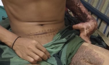 2 Tahun Tanggung Luka Bakar Dan Cacat Permanen, Korban Kecelakaan PT Thaka Sukses Mandiri Tuntut Kejelasan Dan Hak Pekerja