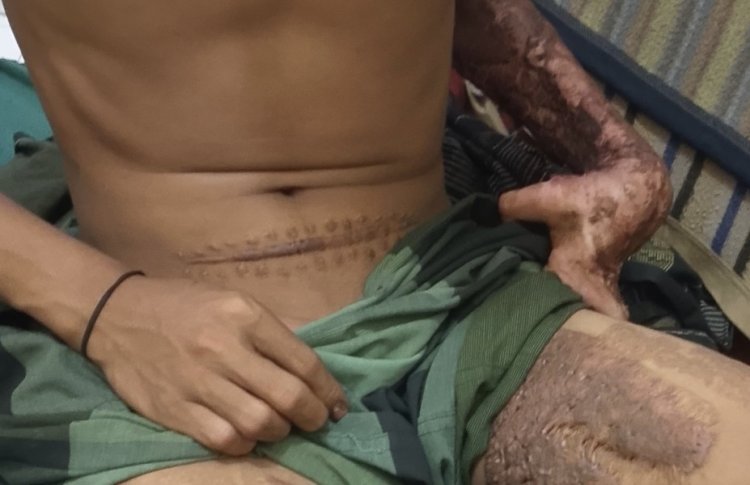 2 Tahun Tanggung Luka Bakar Dan Cacat Permanen, Korban Kecelakaan PT Thaka Sukses Mandiri Tuntut Kejelasan Dan Hak Pekerja